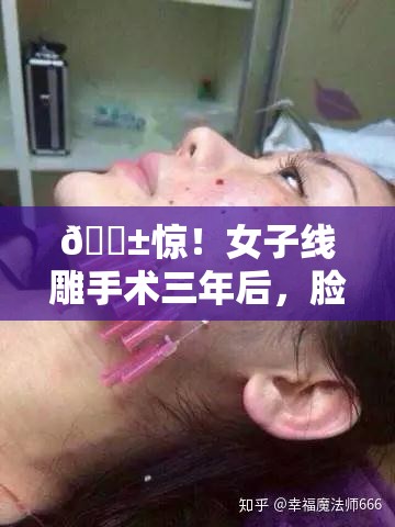 女子线雕手术三年后脸上钻出一根线